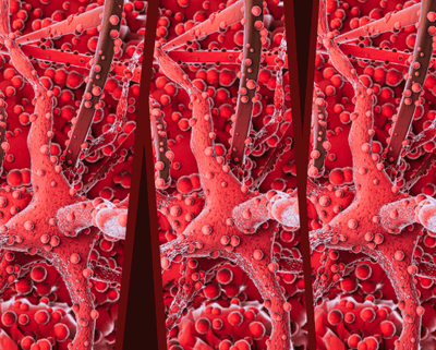Stem Cell Transplants and Cell Therapies for MDS